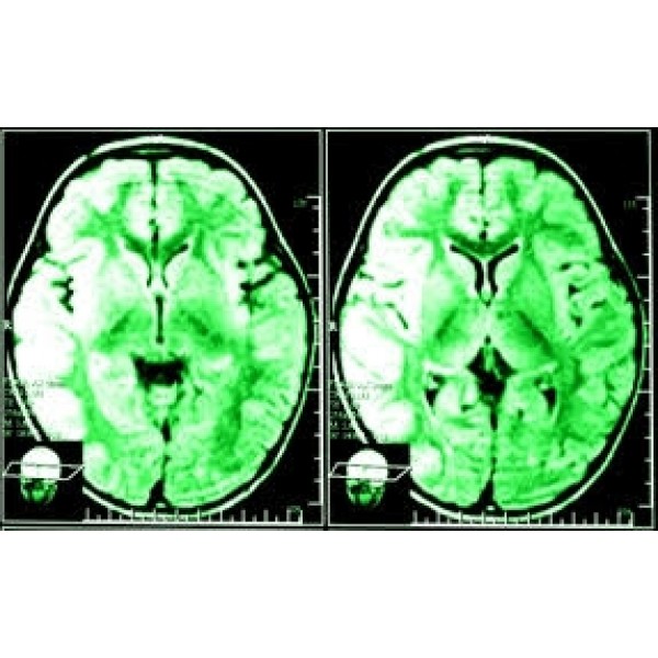 Clínicas para Depressão Onde Achar em Mogi das Cruzes - Como Curar Depressão