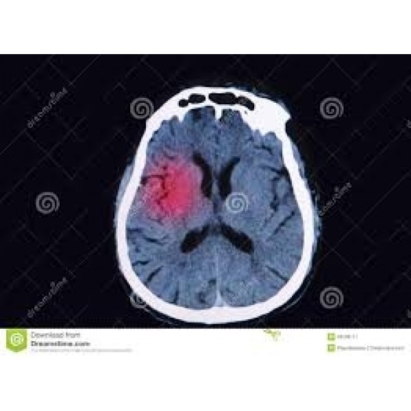 Clínicas para Depressão Preços Acessíveis na Freguesia do Ó - Como Curar Depressão