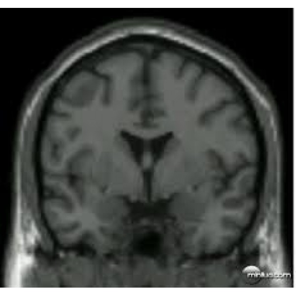 Clínicas para Depressão Valor Baixo em Ermelino Matarazzo - Como Sair da Depressão em Moema