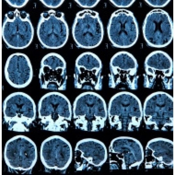 Terapia para Depressão com Preços Acessíveis em Guianazes - Terapia para Pessoas Depressivas