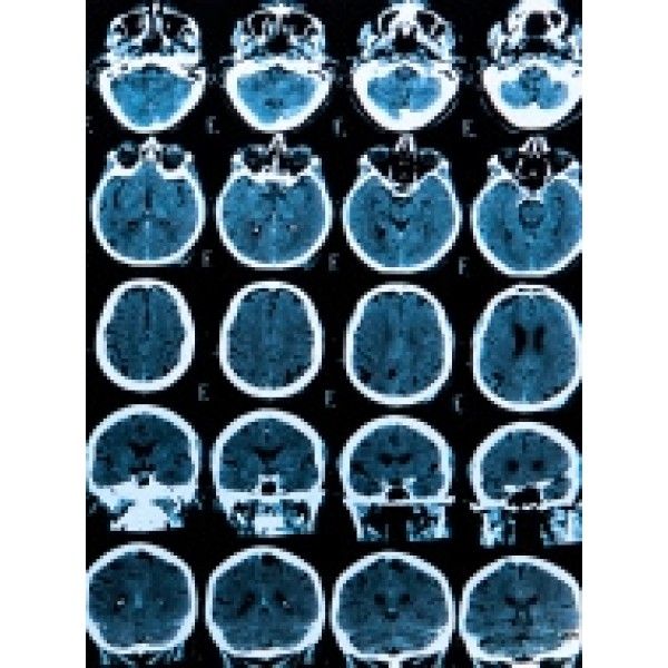 Terapias Alternativas para Depressão Melhores Opções em Itaquaquecetuba - Terapia Cognitiva Comportamental Depressão