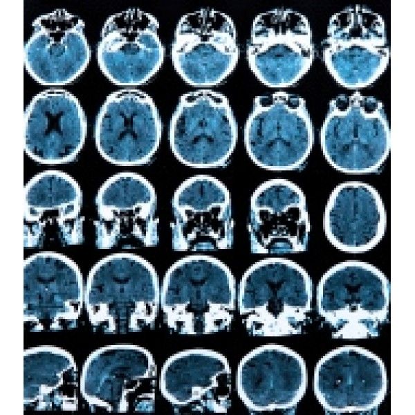 Terapias Alternativas para Depressão Preços Baixos em Itapecerica da Serra - Terapia para Depressão no Itaim Bibi