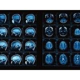 Clínica para depressão melhores preços em Biritiba Mirim