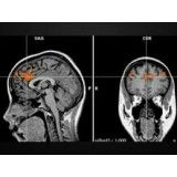 Clínica psiquiátrica para depressão preços em Embu Guaçú