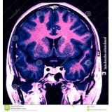 Clínicas para depressão valor em Cajamar